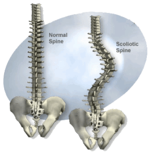 escoliosis